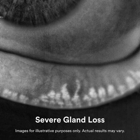 Photo of Severe Gland Loss